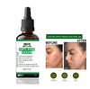 Arfa Cosmetics 2% Salicylic Acid Acne Serum For Pimples & Acne Marks Oil Control Face Serum 30ML